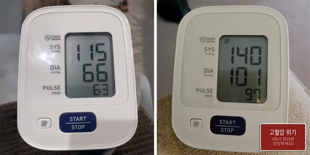 Derila sleep apnea 2 hypertensive crisis C GG KO